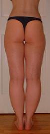 before agter liposuction thighs
