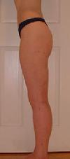 before after liposuction calves ankles