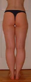 before after liposuction calves ankles
