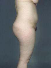 before after liposuction thighs