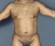 before after liposuction male chest abdomen flanks