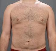 before after male abdominoplasty tummy tuck