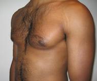 before after liposuction male chest