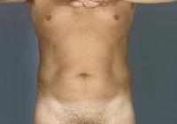 before after liposuction male abdomen flanks