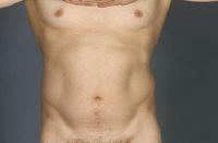 before after liposuction abdomen flanks male