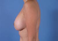 before after breast augmentation
