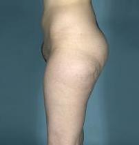 before after liposuction thighs