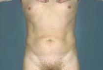 before after liposuction male abdomen flanks