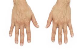 before/after radiesse hands