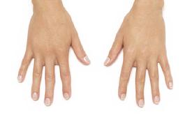 before/after radiesse hands